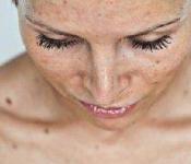 Коричневые пятна на коже — причины появления